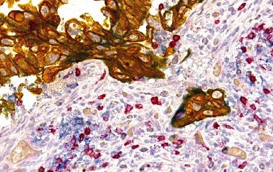 Lung Adenocarcinoma: PD-L1, CD8, PanCK (1). PD-L1 on both macrophages & cancer tissue.